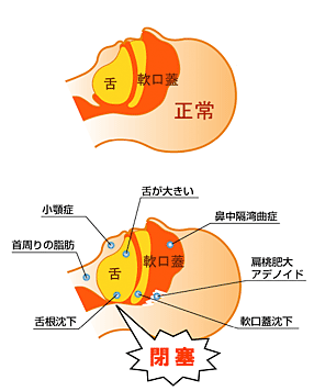 睡眠時無呼吸症候群について 内科 岩井グループ