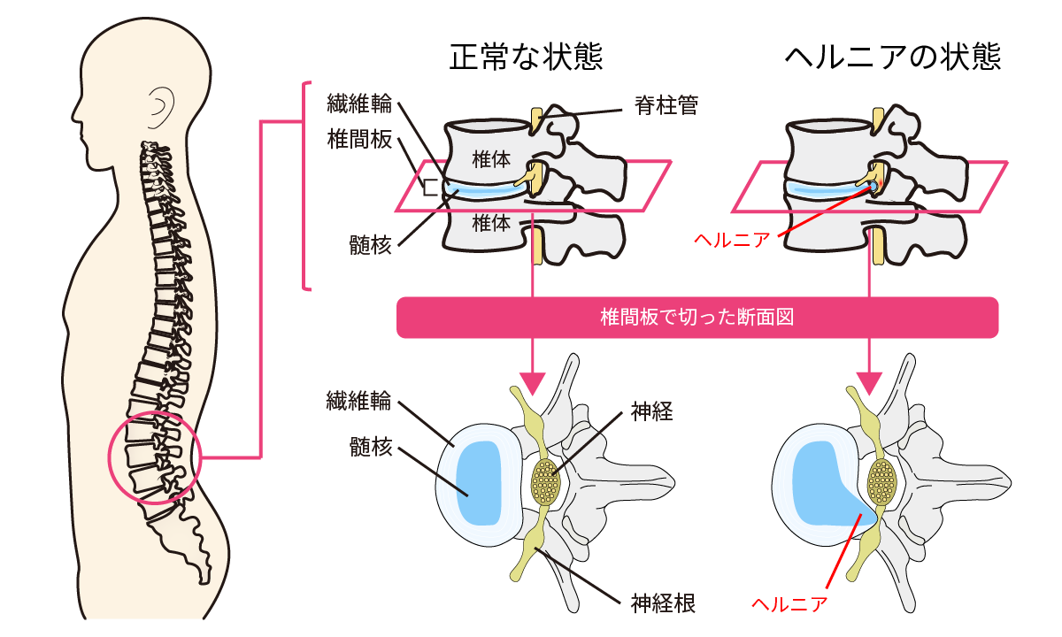 椎間板ヘルニアの手術について｜岩井整形外科病院