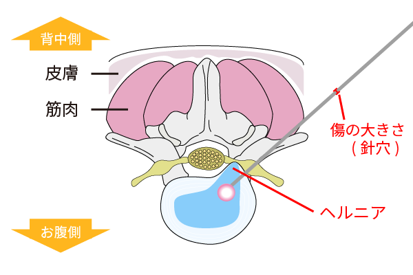 PLDD：椎間板ヘルニアのレーザー治療｜岩井整形外科病院