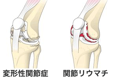 人工膝関節置換術｜岩井整形外科病院