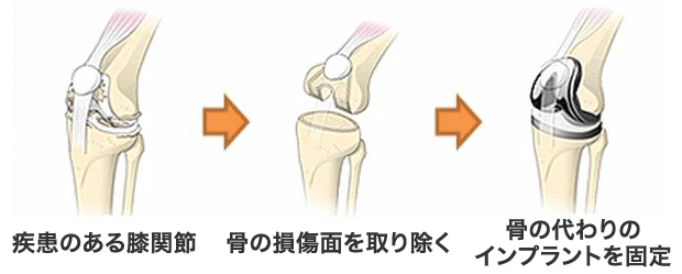 人工膝関節置換術｜岩井整形外科病院