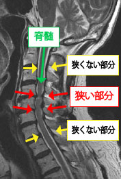 頚椎ヘルニア、頚部脊柱管狭窄症の手術について｜岩井整形外科病院