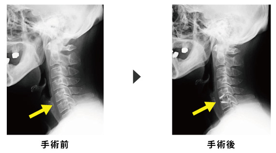 頚椎前方固定術 頚椎椎間板ヘルニアの内視鏡下手術 岩井整形外科内科病院